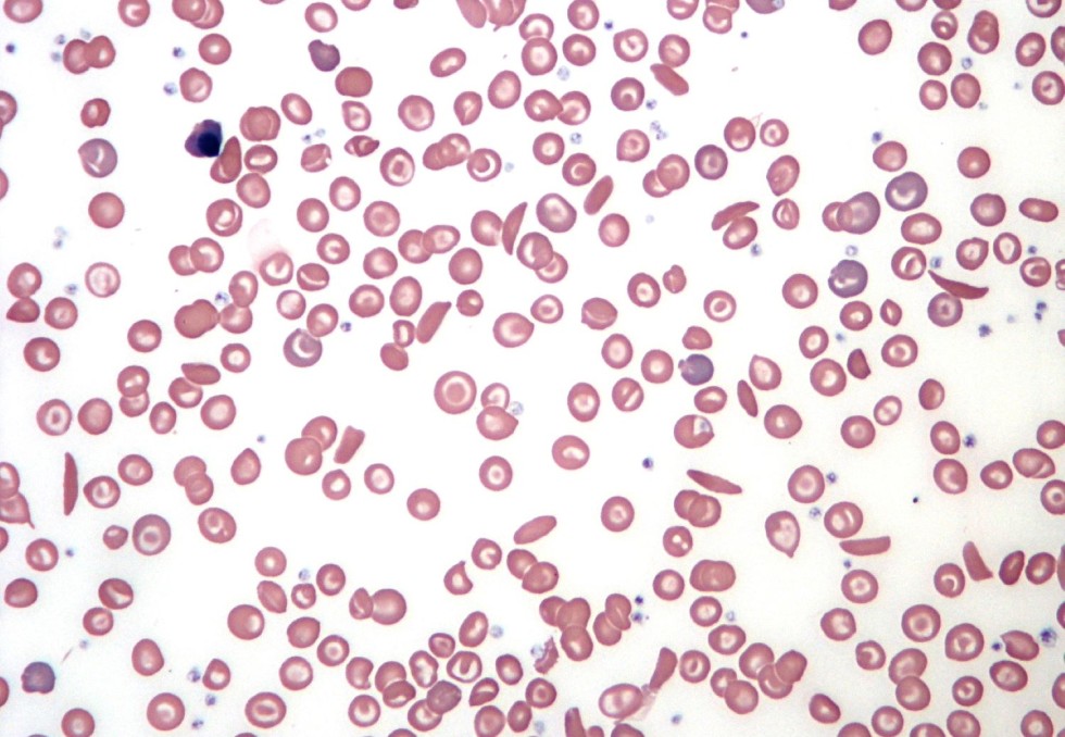 Drépanocytose