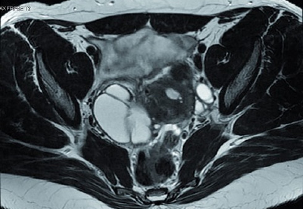endométriose