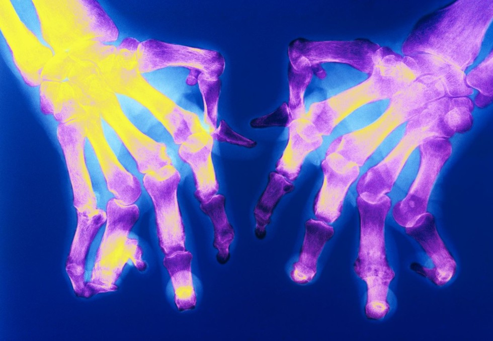 polyarthrite rhumatoïde