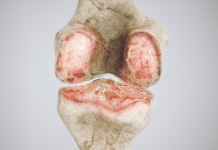arthrose