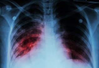 tuberculose