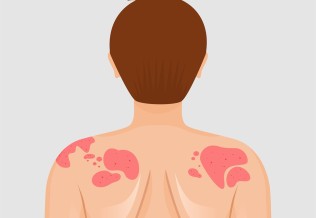 eczema