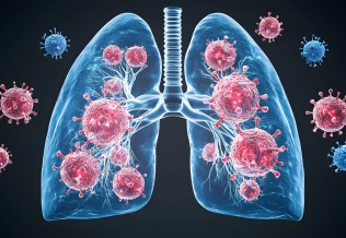 metastase