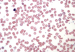 Drépanocytose 