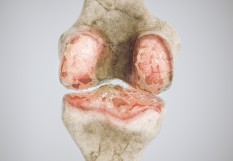 arthrose