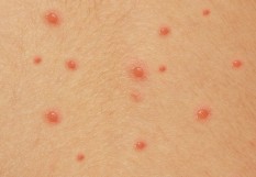 Varicelle