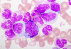 Leucémie aigüe myéloïde