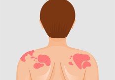 eczema