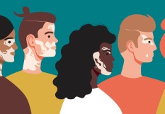 vitiligo