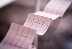 ecg