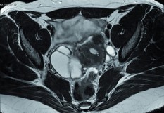 endométriose